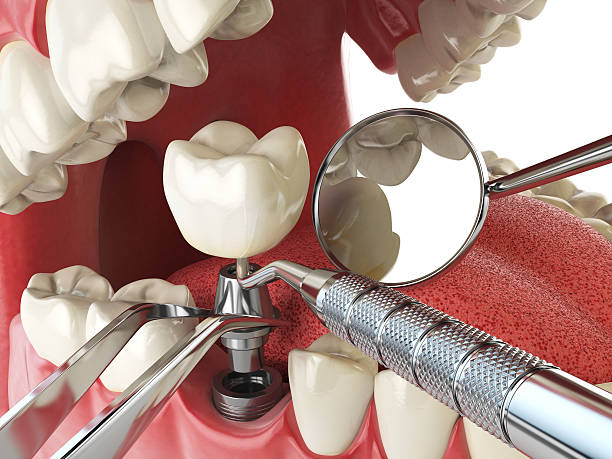 Best Emergency Tooth Extraction in Hustisford, WI